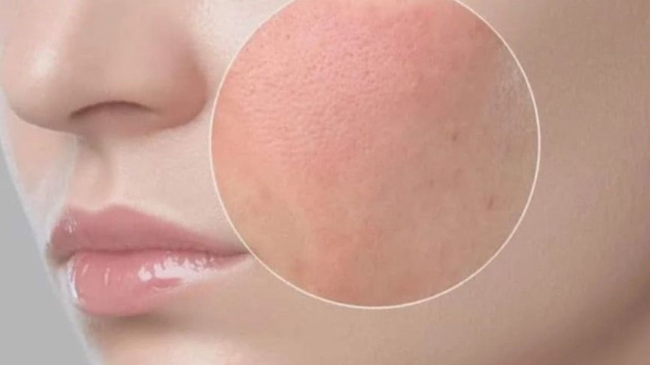 rosacea cos'è rimedi