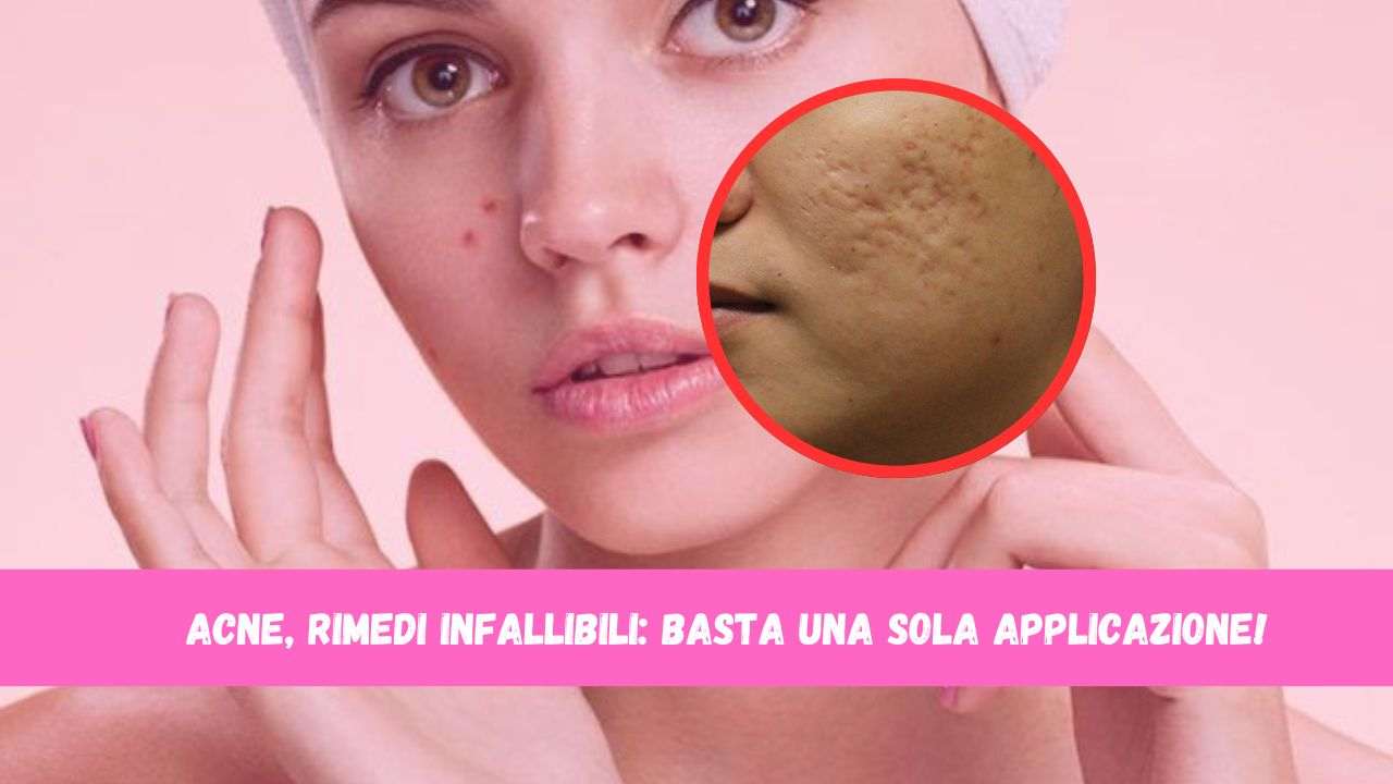 acne rimedi